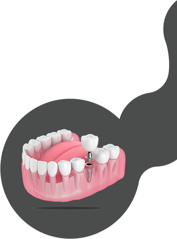 Dental Implant Tooth