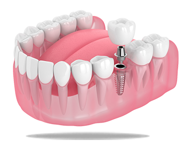 Dental Implant Tooth